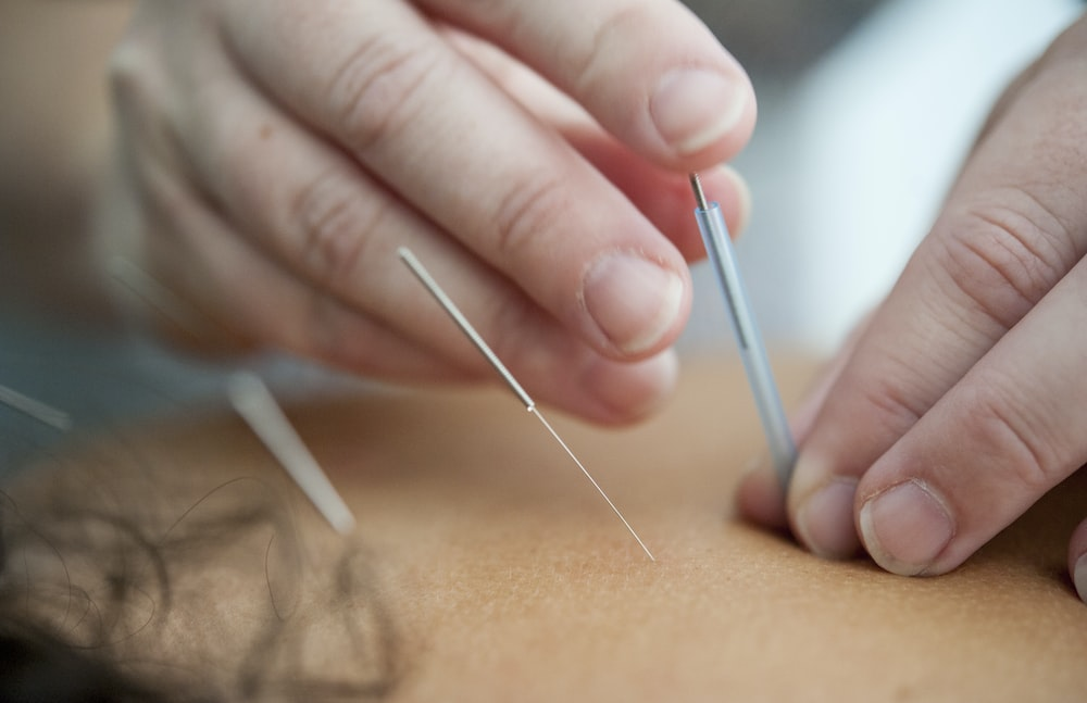 an acupuncture therapist inserting needles