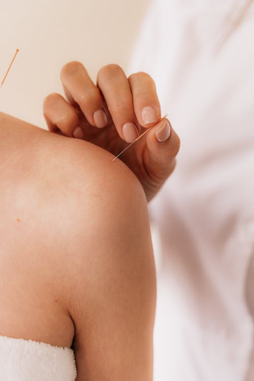 an acupuncturist inserting an acupuncture needle