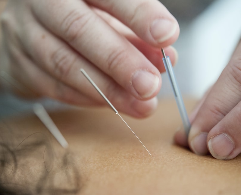 a person getting acupuncture therapy.