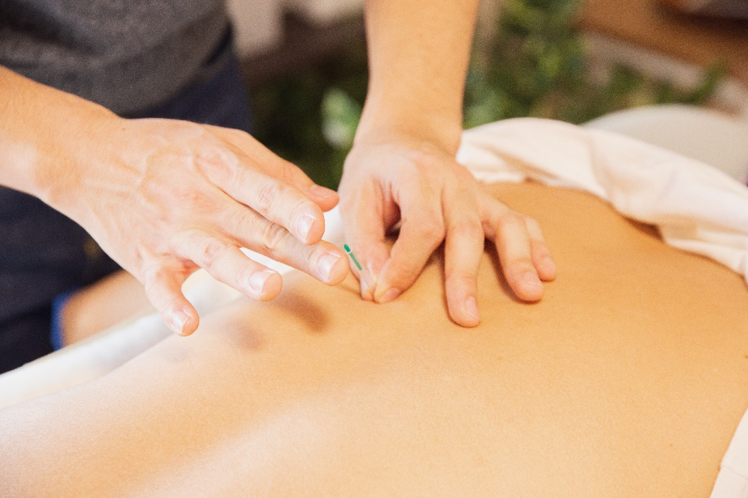 10 Benefits of Dry Needling for Your Well-being