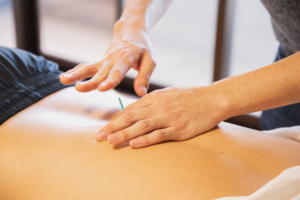 A person getting a dry needling session